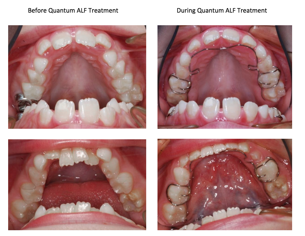 Quantum ALF "Stealth" Orthodontics - Bronson Family Dentistry