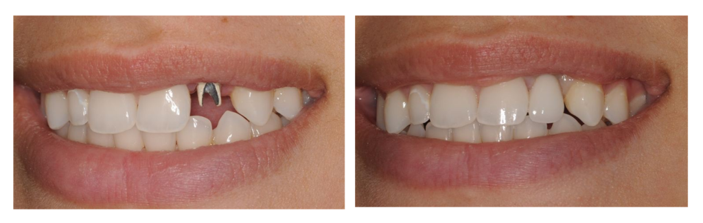 tooth implant before after