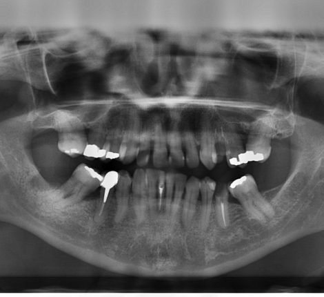 Resin Bonded Fillings - Bronson Family Dentistry