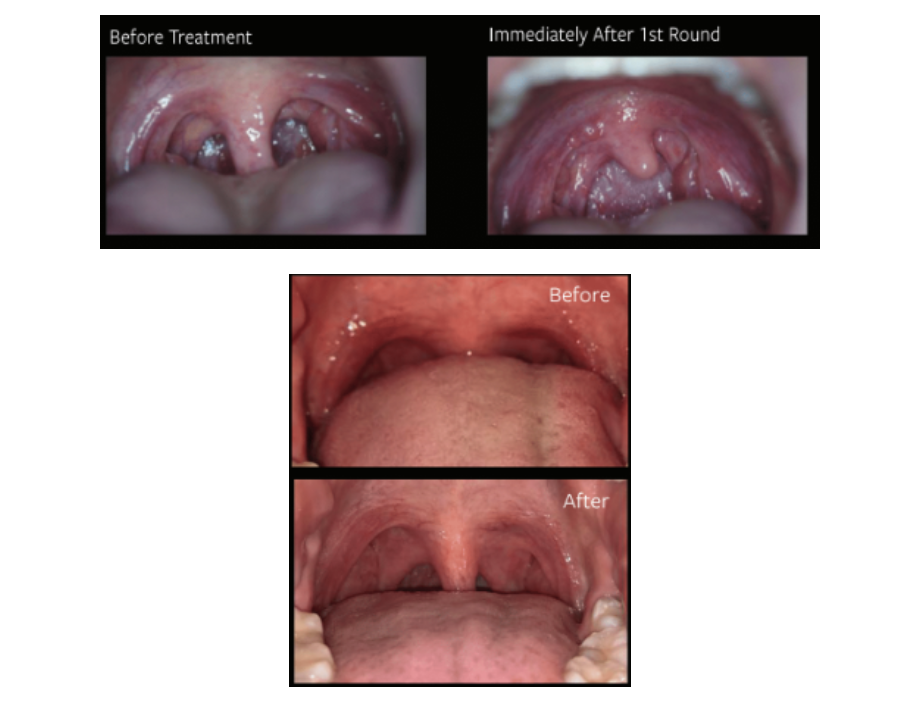 Fotona Laser Treatment in McLean, Virginia Before and After